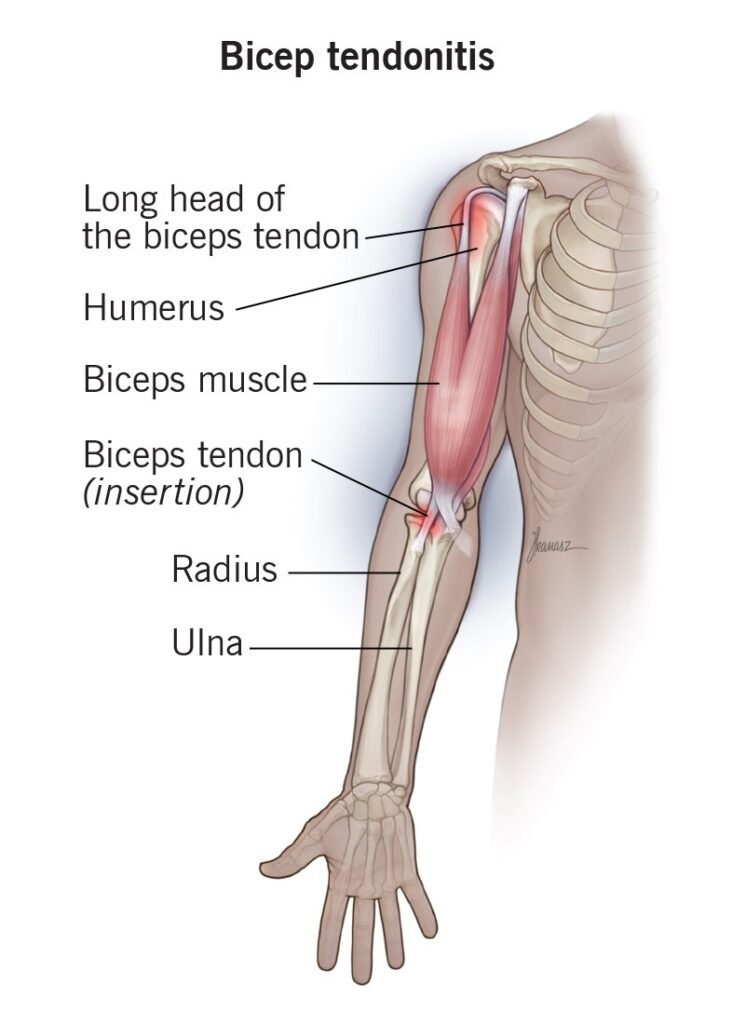 Biceps Tendonitis Treatment in Bahadurpura, Hyderabad