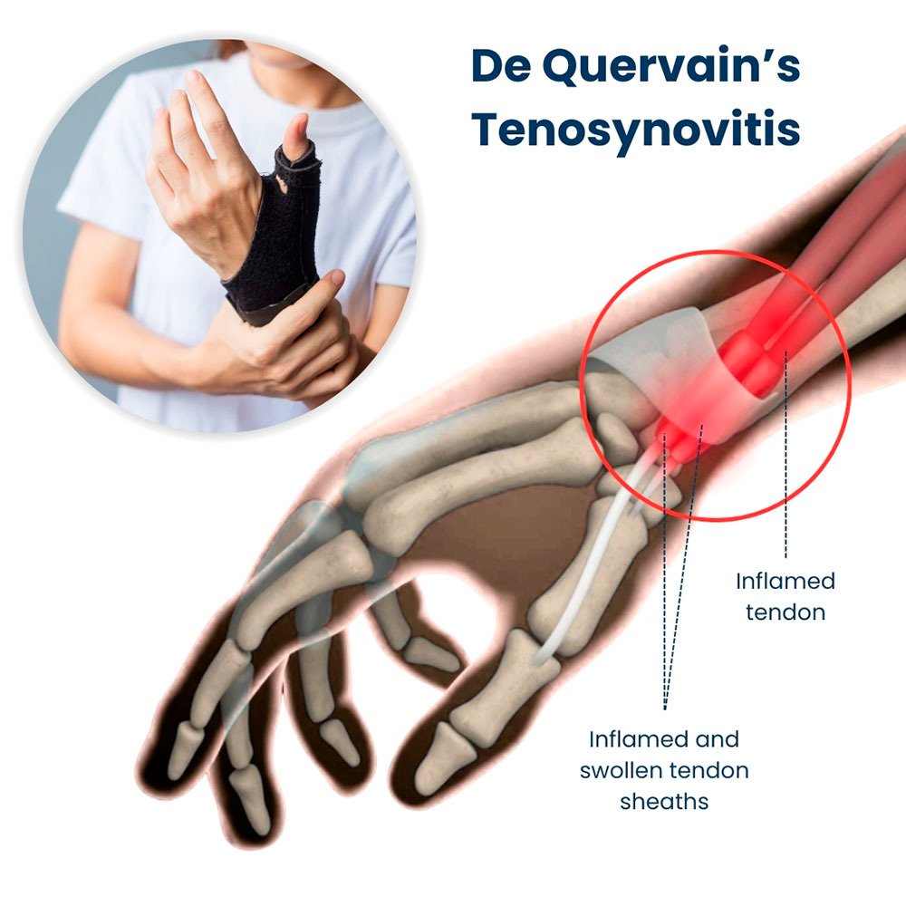 De Quervain’s Tenosynovitis