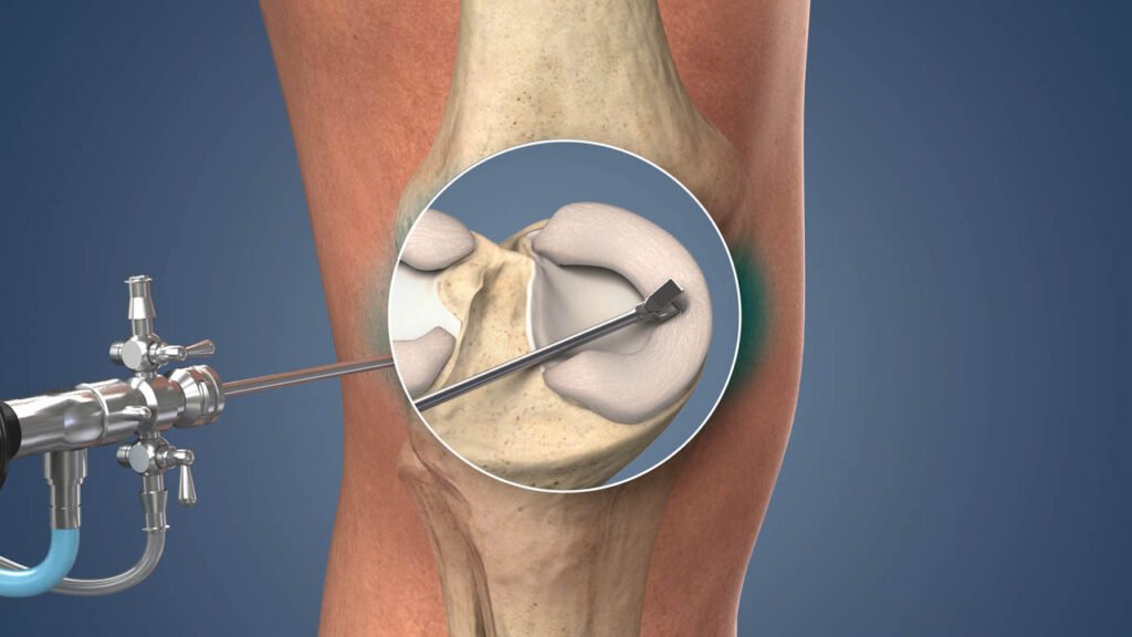 Knee Arthroscopy in Bahadurpura, Hyderabad