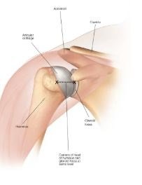 Total Shoulder Replacement in Bahadurpura, Hyderabad