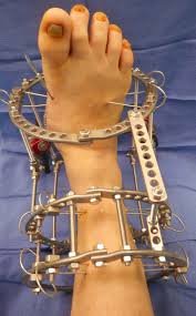 External Fixation